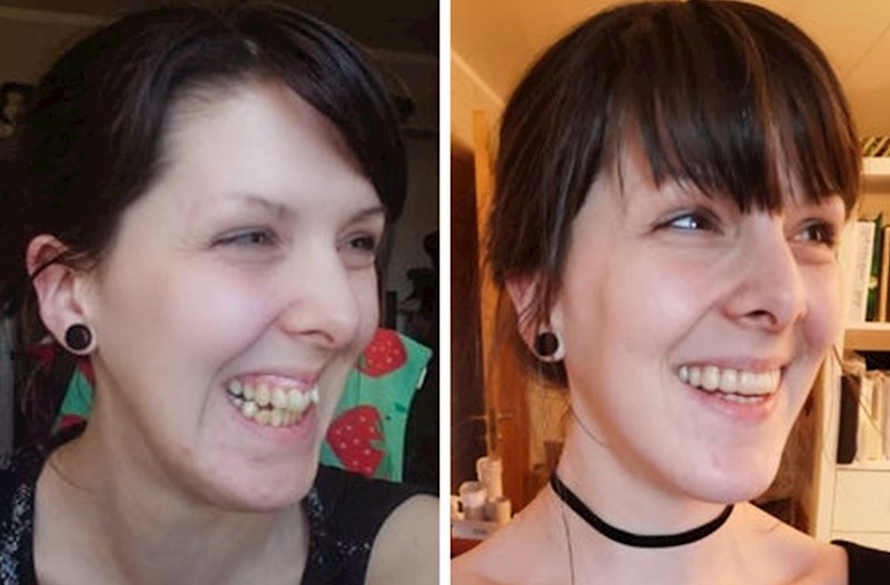 "Ovako izgleda dvije godine aparatića, uklanjanje umnjaka i dvije dvostruke operacije čeljusti!"