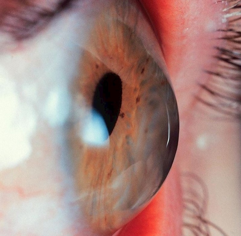 Rožnica je jedini dio tijela bez opskrbe krvlju, kisik dobiva izravno iz zraka