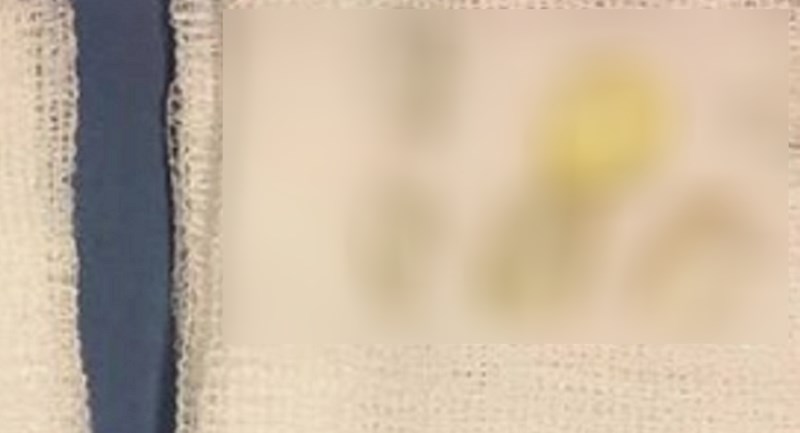 Žena se žalila na bolove u oku, doktori su se zgrozili kada su otkrili uzrok