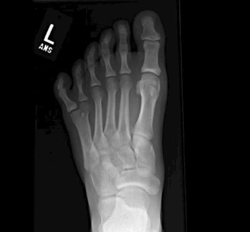 Snimka stopala sa 6 prstiju