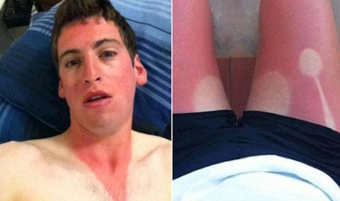 23 ljudi koji su se zaboravili namazati kremom za sunčanje