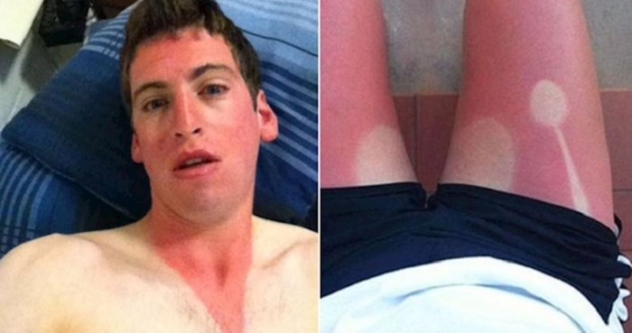23 ljudi koji su se zaboravili namazati kremom za sunčanje