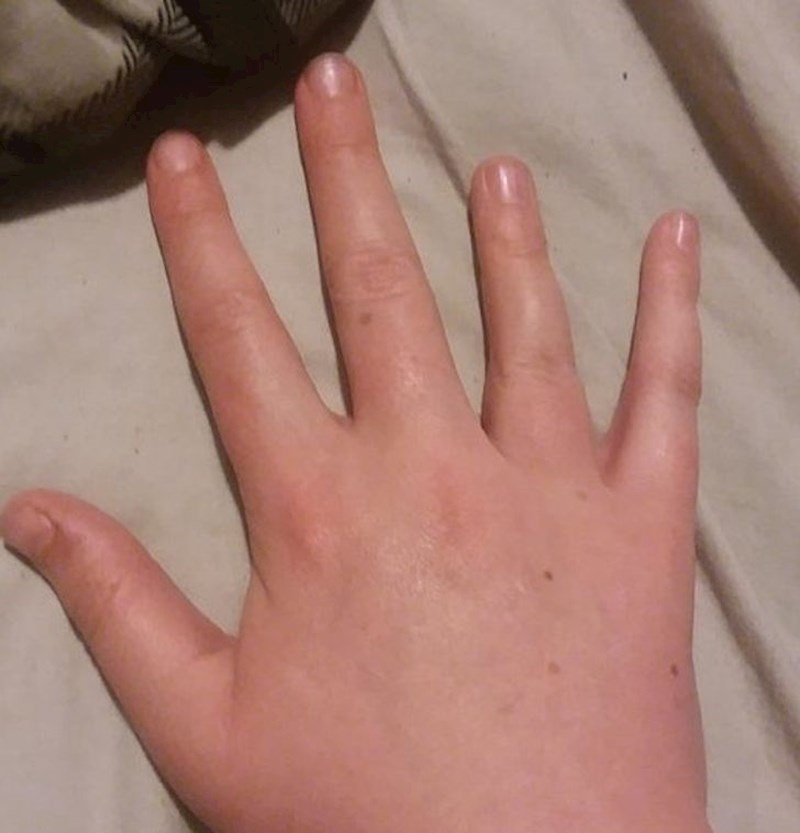 "Izgleda kao da imam 2 mala prsta na ruci"