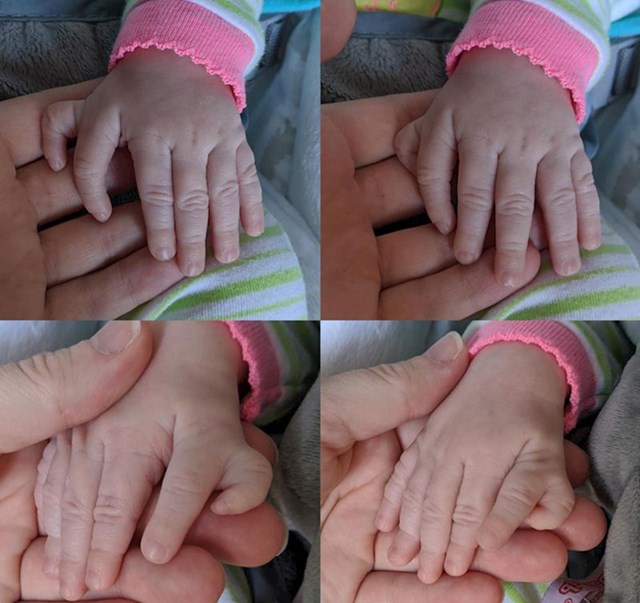 Djevojčica rođena sa šest prstiju na svakoj ruci