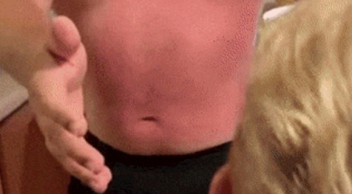 Lik je htio dokazati koliko je jako izgorio na suncu, ovo je urnebesno