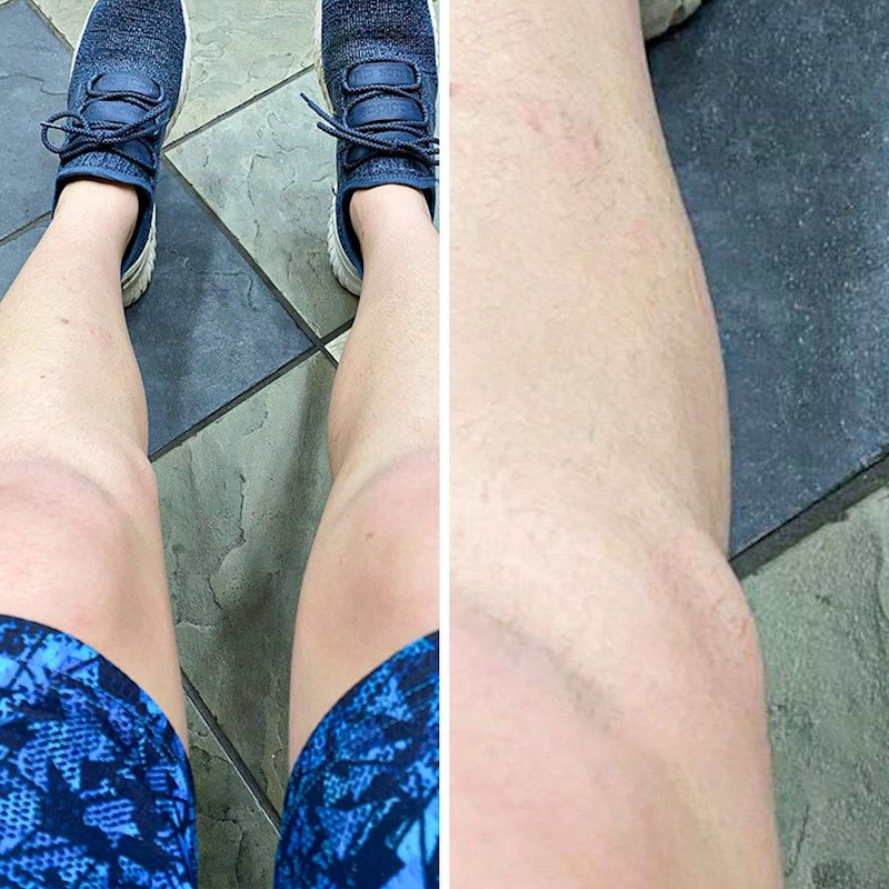 "Imam jednu kost viška pored koljena..."