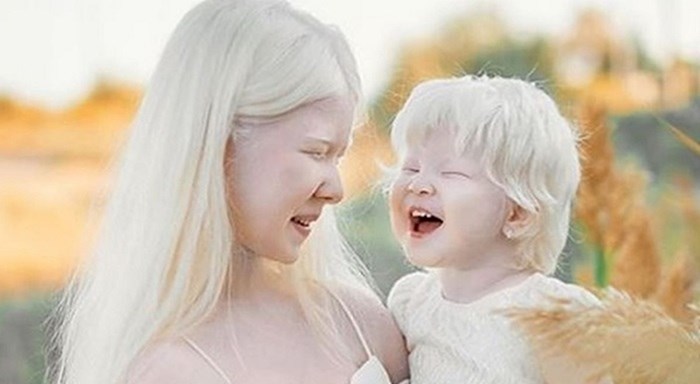 Između ovih sestara 12 je godina razlike, a obje su rođene s albinizmom