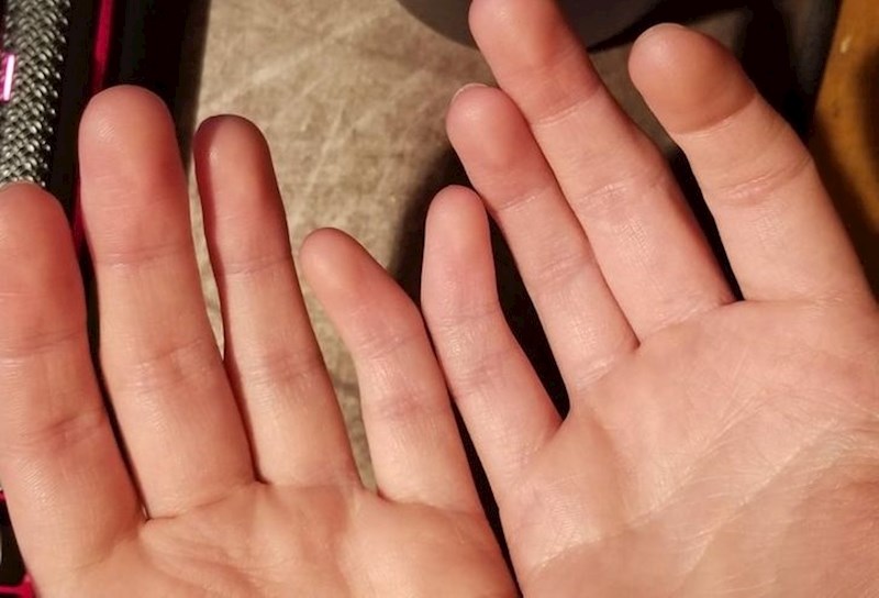 "Imam krive prste od rođenja"