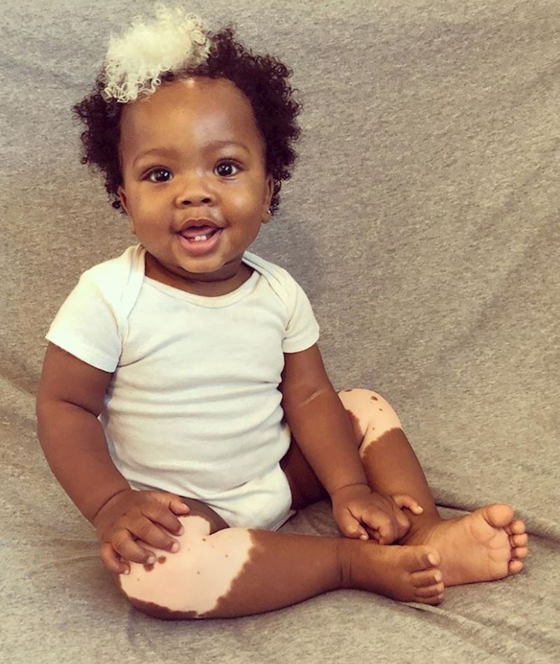 Djevojčica s vitiligom