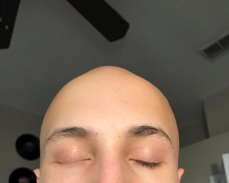 "Nemam trepavice na jednom oku..."