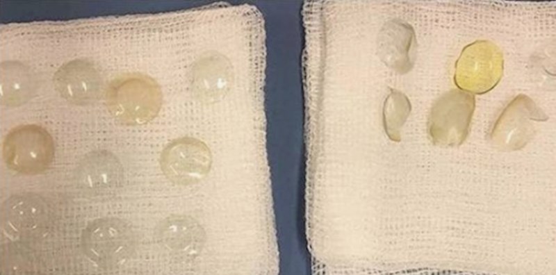 Kirurzi su joj pronašli 27 leća u oku