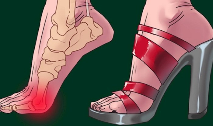 Visoke pete ne ugrožavaju samo vaša stopala, ovim dijelovima tijela čine veliku štetu