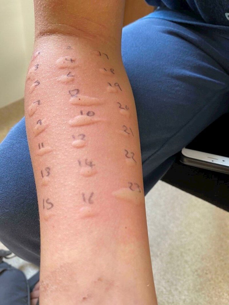 "Moj sin je alergičan na sve"