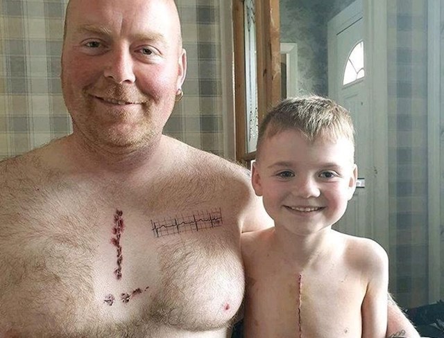 Ovaj tata si je istetovirao ožiljak na prsima koji njegov sin ima nakon operacije srca