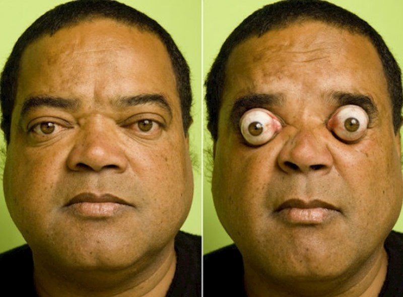 Ovaj čovjek može najviše ispupčiti očne jabučice