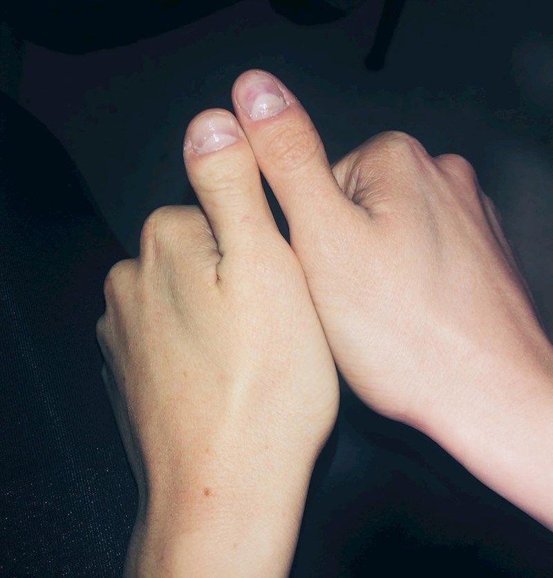 "Imam različite palčeve"