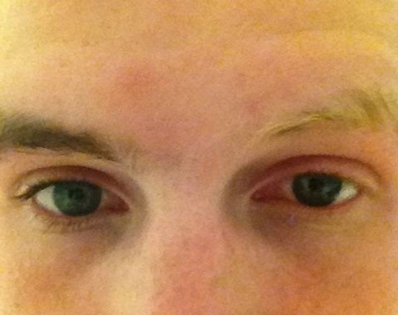 "Rođen sam s različitom bojom obrva i trepavica"