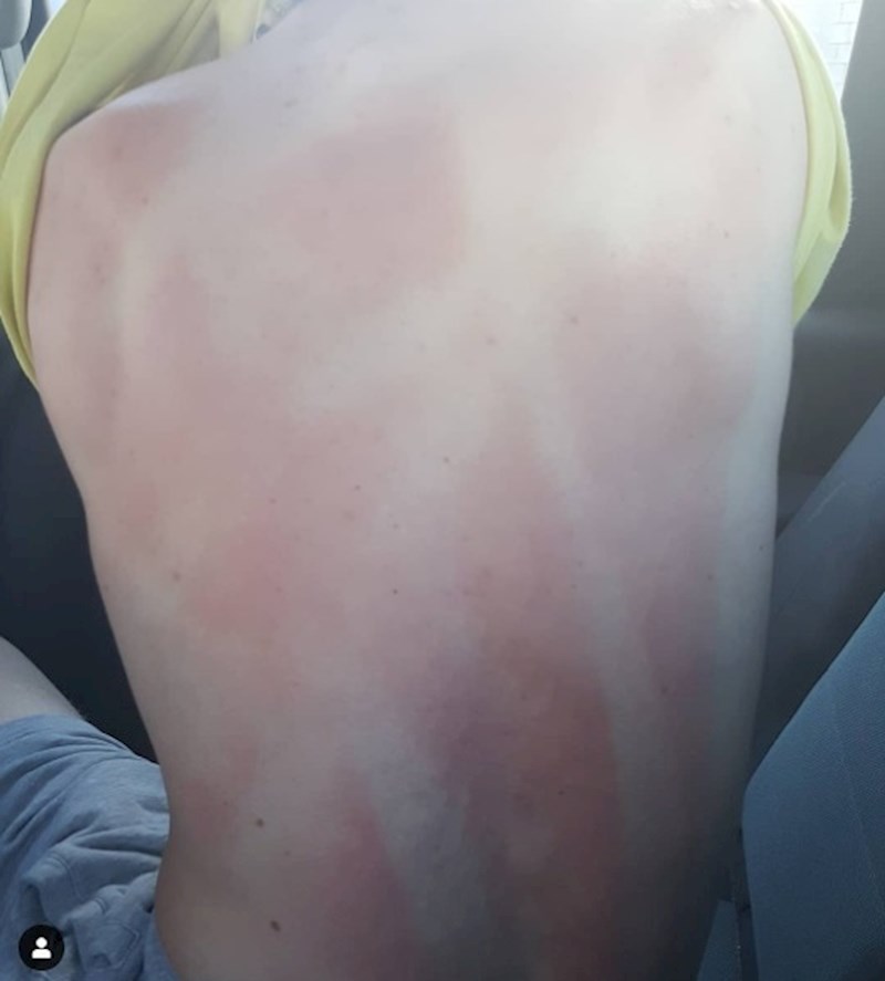 Ovo se desi kada sprej za sunčanje koristite po vjetrovitom vremenu