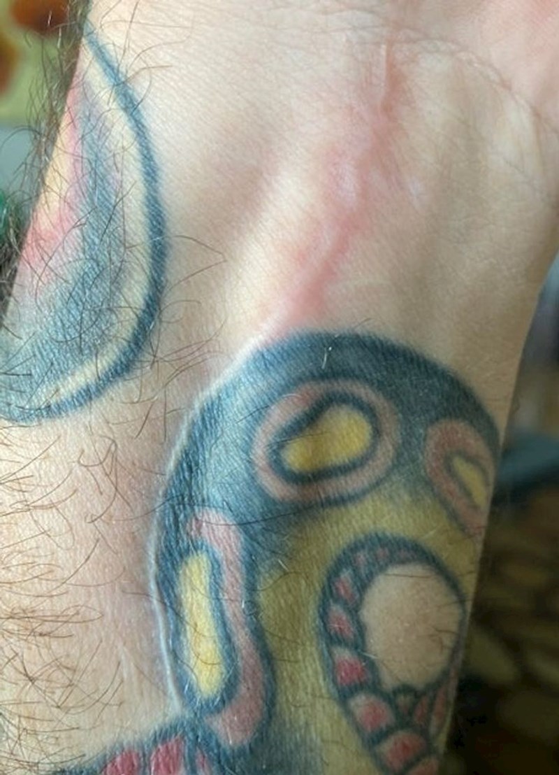 Kirurg je izbjegao tetovažu