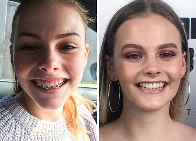 "5 godina sam radila na mom osmijehu: aparatić, dvostruka operacija čeljusti, operacija sinusa i zubni implantanti. Presretna sam rezultatom!"