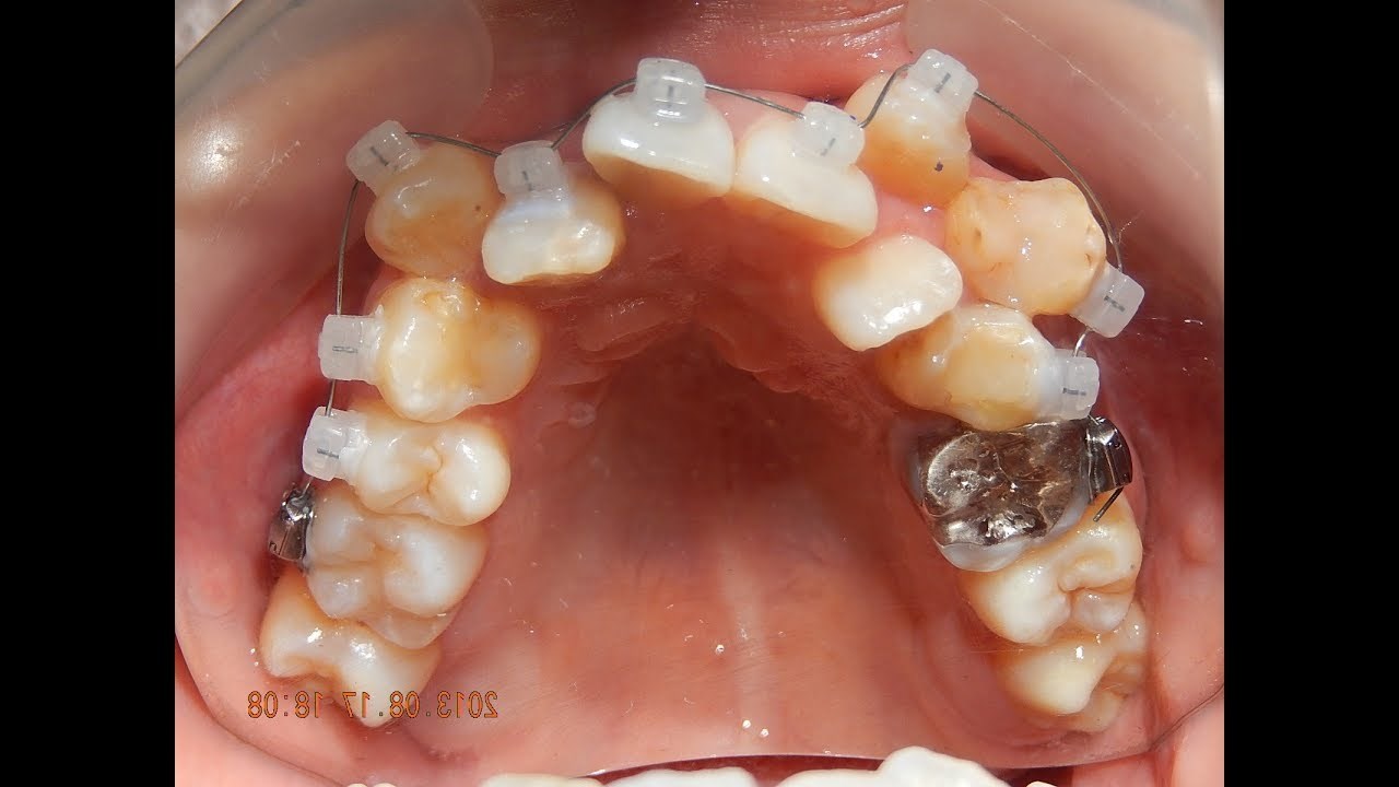TAKO JEDOSTAVNO, A RADI ČUDA Ovaj video će svakoga uvjeriti da je fiksni aparatić za zube genijalan izum
