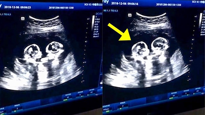 Roditelji su se začudili kad su na ultrazvuku vidjeli što njihove blizanke rade
