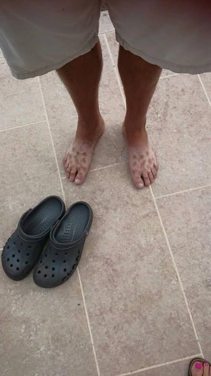 Ovaj čovjek je na smiješan način naučio da hodanje po suncu u kroksicama nije dobro