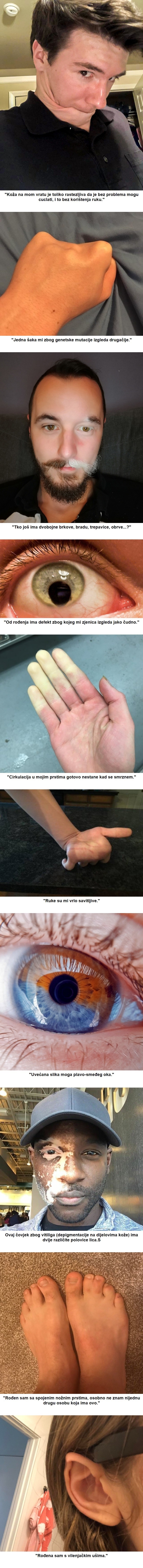 10 ljudi s nesvakidašnjim genetskim promjenama koje ih čine uistinu posebnima