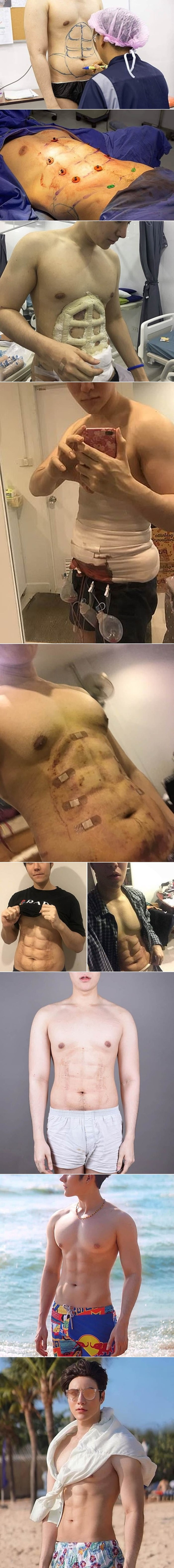 Potrošio je 26 000 kuna na operaciju kako bi mu napravili lažne trbušne mišiće, evo kako sad izgleda