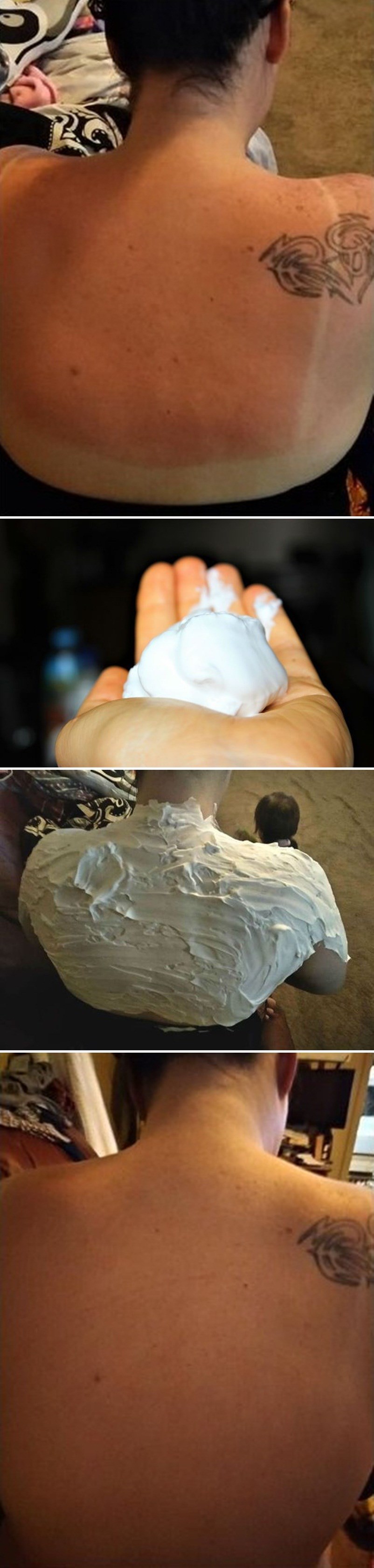 Mama je izgorjela na suncu pa isprobala nešto što joj je opekline izliječilo u nekoliko sati