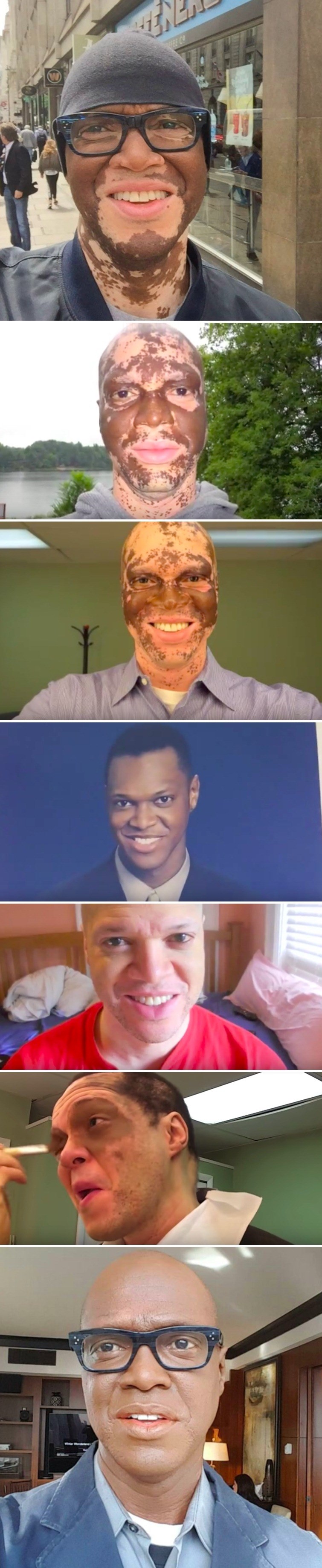 Novinar s televizije svaki dan šminka lice kako mu kožna bolest ne bi uništila karijeru