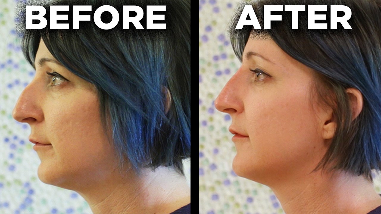 VIDEO Novom metodom im je poravnao nos te postigao čudesne rezultate u samo nekoliko minuta