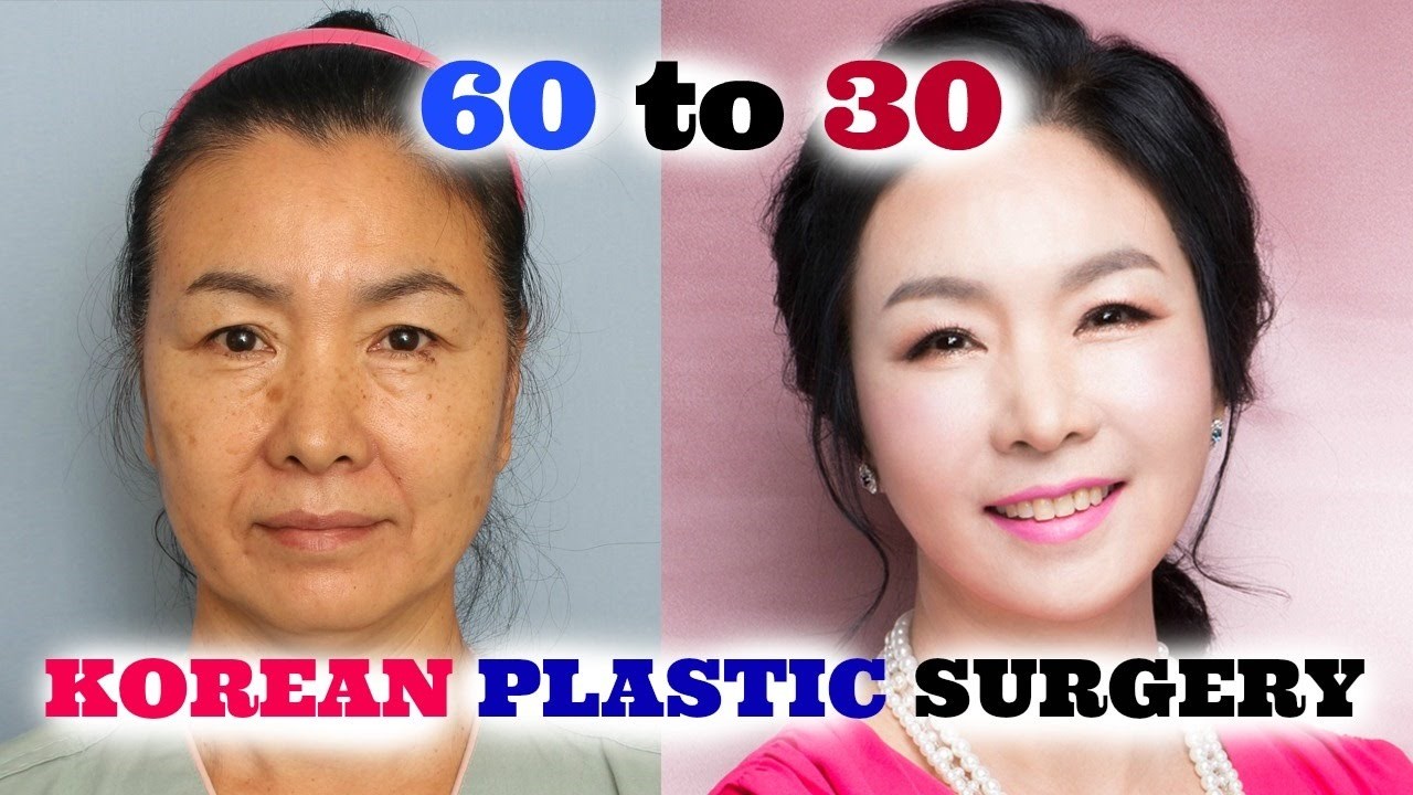 VIDEO Kćer je dokumentirala mamine estetske operacije, nećete vjerovati kako je na kraju izgledala