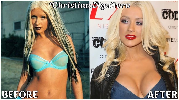 Sve ove poznate žene išle su na istu operaciju, pogledajte kako su izgledale prije, a kako nakon nje