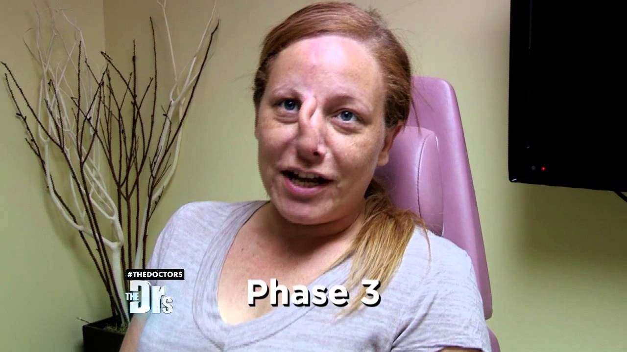 Dečko joj je nakon svađe odgrizao nos, nećete vjerovati kako izgleda nakon savršeno obavljenih operacija