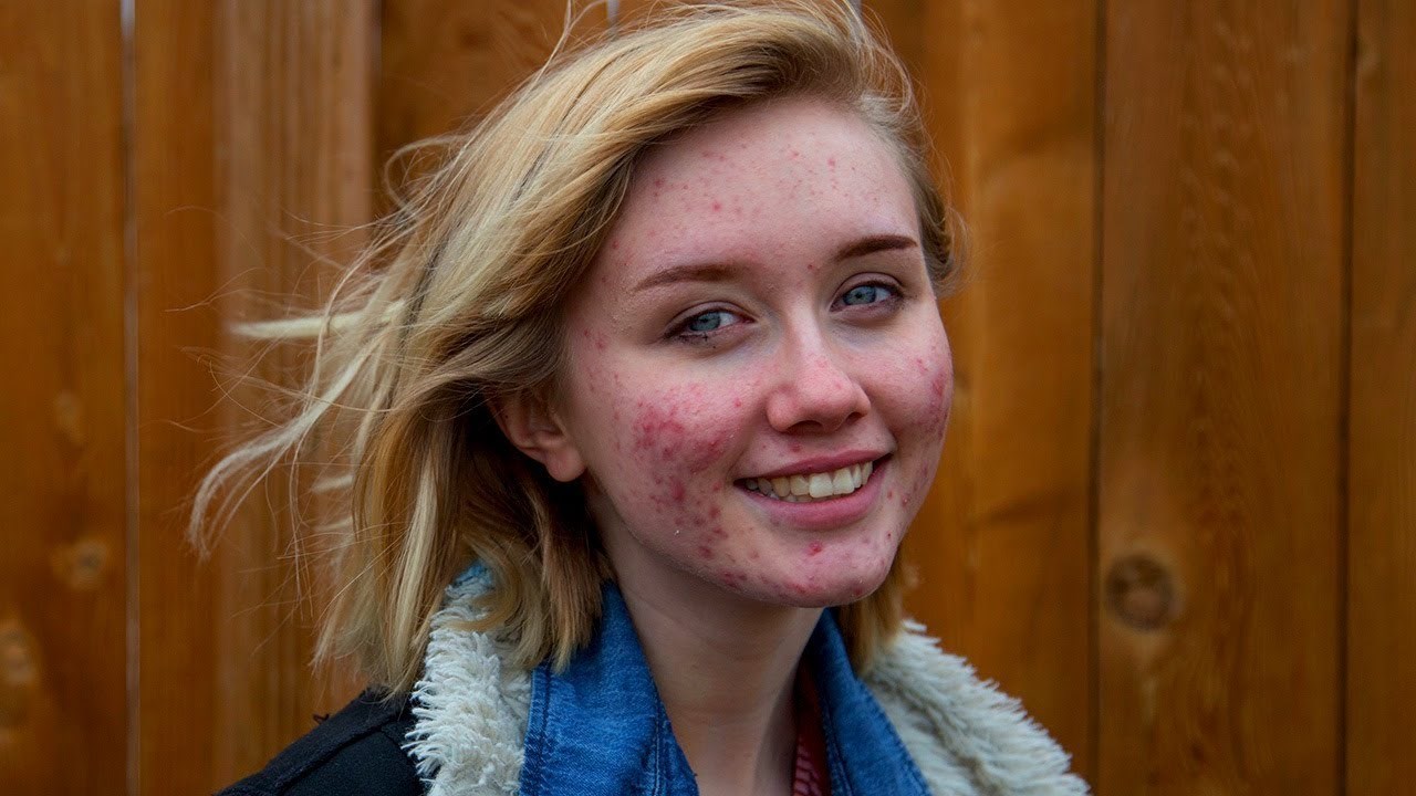 VIDEO Iako ima probleme s aknama, odlučila je prestati koristiti šminku, sada je sretnija nego ikad