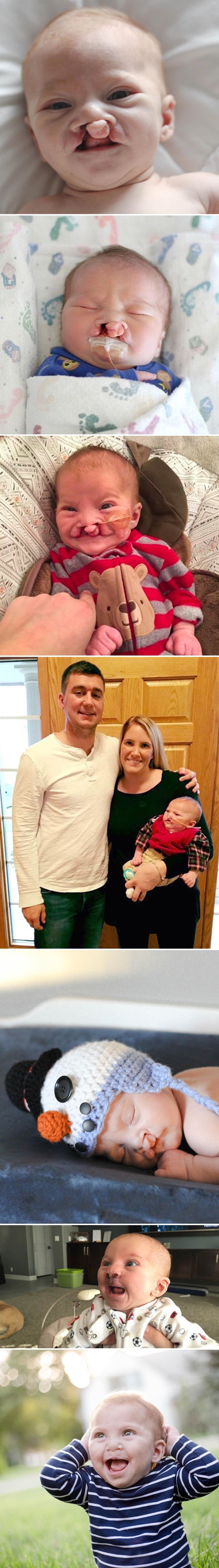 Roditelji nisu htjeli odustati od svoje "deformirane" bebe, pogledajte kako ona danas izgleda!