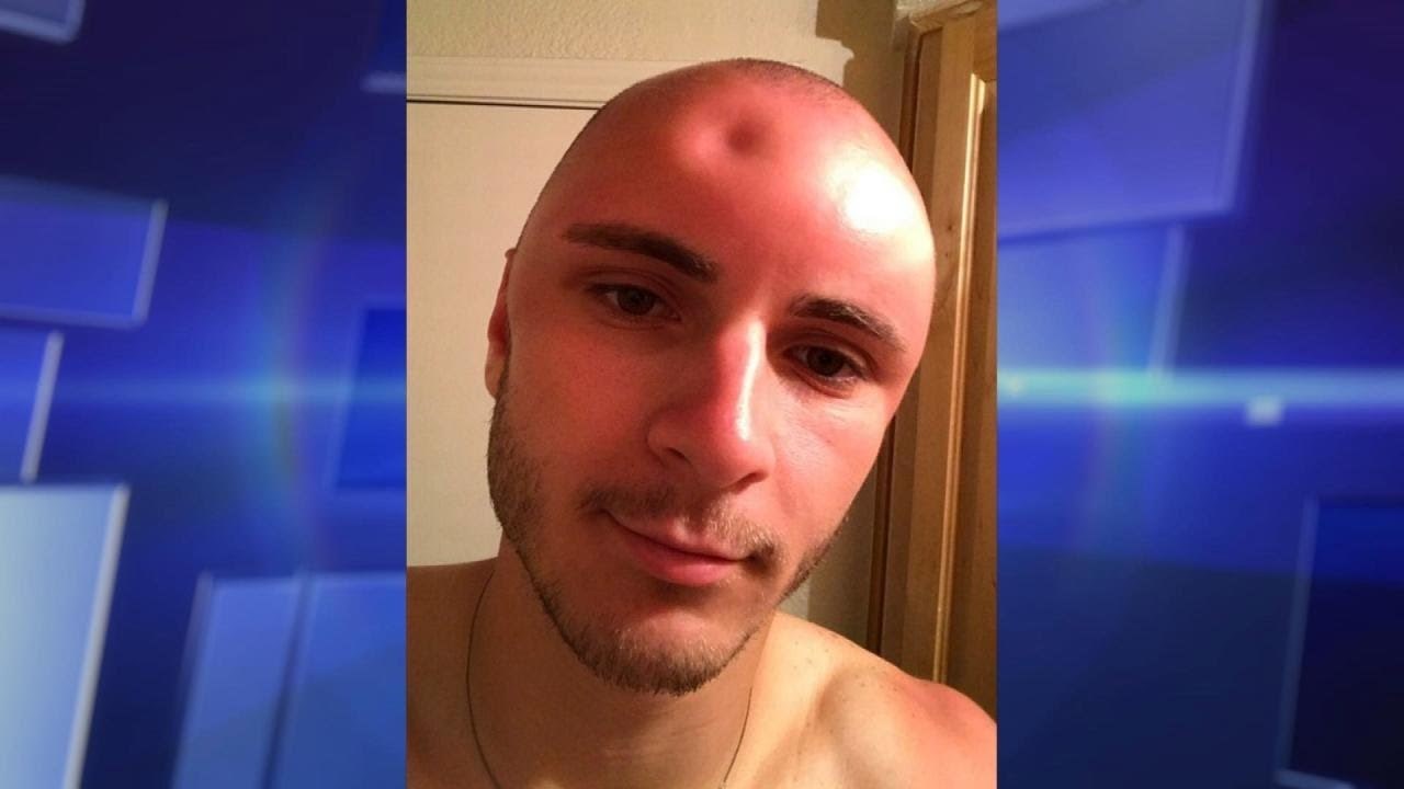 VIDEO Mladić je izgorio na suncu pa kasnije primijetio nešto uznemirujuće na glavi