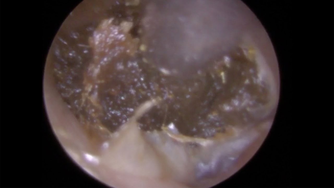 VIDEO Doktor je snimio najekstremniji slučaj vađenja smole iz uha, pogledajte što je našao unutra