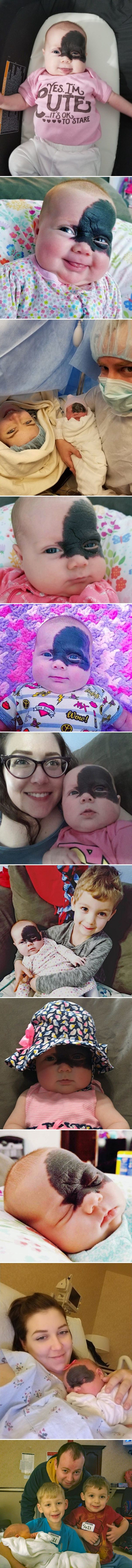 Ova beba je zbog promjene na koži dobila presladak nadimak i osvojila mnoga srca