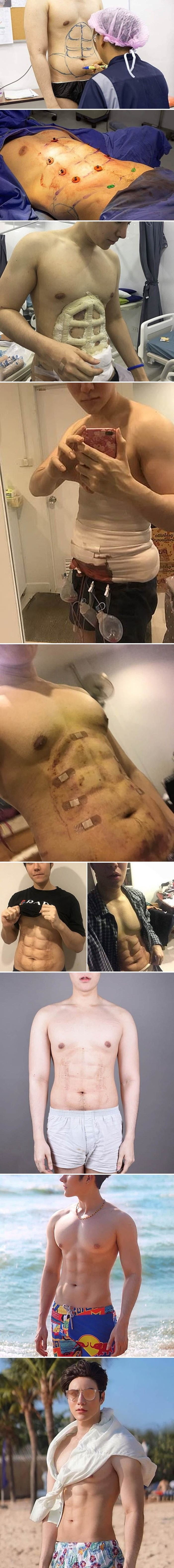 Platio je tisuće dolara kako bi mu operacijom napravili lažne "pločice" na trbuhu, evo kako danas izgleda