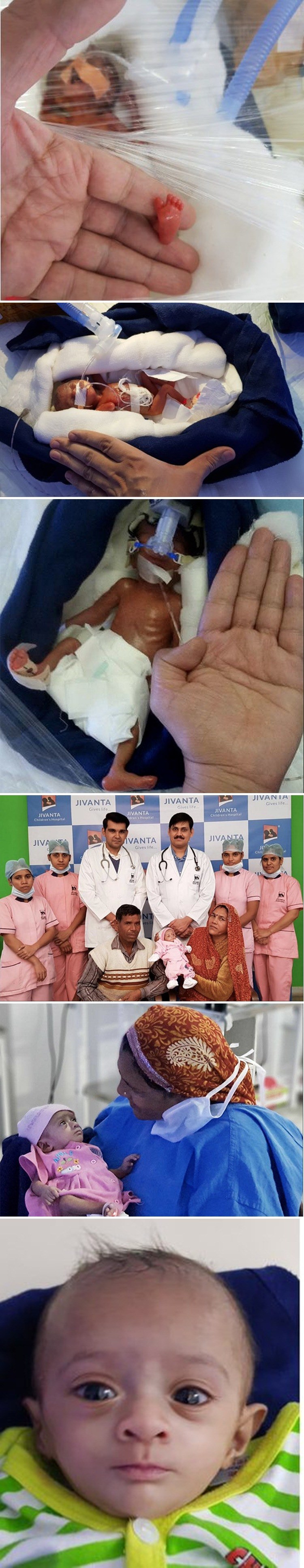 Sićušna beba rođena je 12 tjedana prije redovnog termina, doktori kažu da je jedna od najmanjih ikad