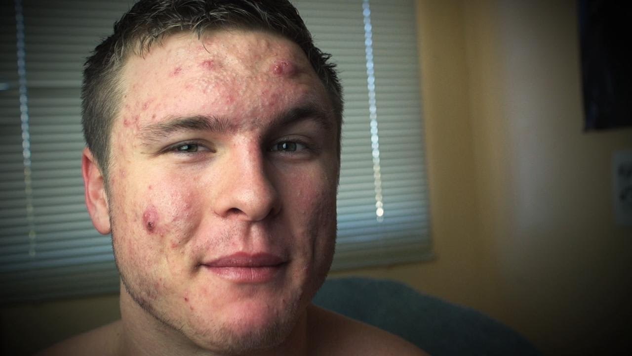 Mladić koji je imao ogromne probleme s aknama otkrio je koje su mu namirnice skroz promijenile izgled