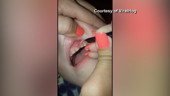 VIDEO Dijete nije htjelo prestati gristi nokte, mama je bila šokirana kad je vidjela što mu je izvukla iz usta