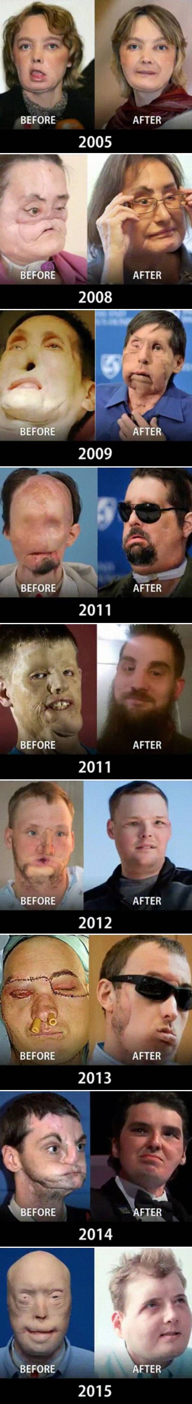 Transplantacije lica postaju sve bolje, ove slike prikazuju odlične rezultate vrhunskih kirurga