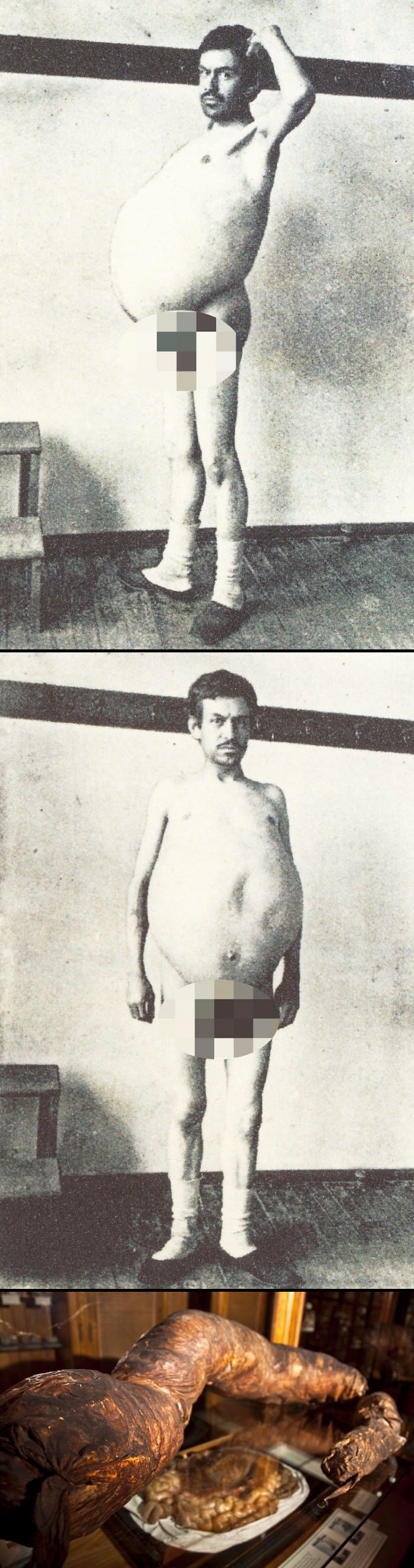 Čudna priča o muškarcu koji je obavljao nuždu samo jednom mjesečno