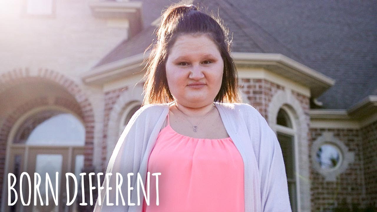 "Imam 23 godine i pretvaram se u kip": Djevojka ima rijetku bolest zbog koje joj raste "drugi kostur"