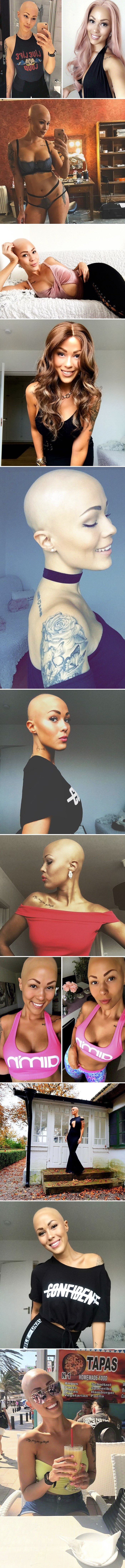 Žena s nesvakidašnjim poremećajem postala model nakon što je svijetu otkrila svoju veliku tajnu