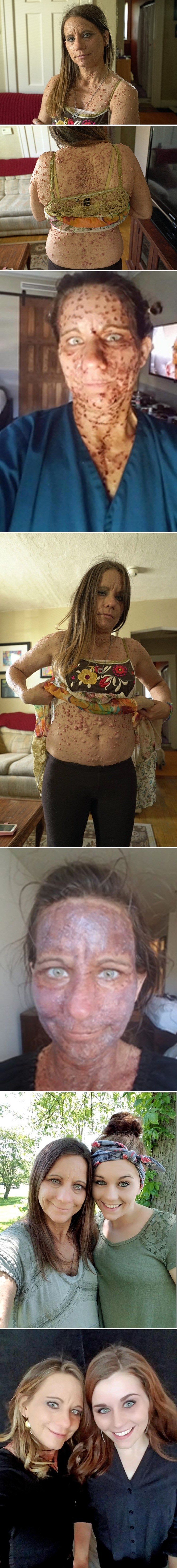 Tijelo joj je bilo prekriveno dobroćudnim tumorima, no operacije su joj omogućile nevjerojatno transformaciju