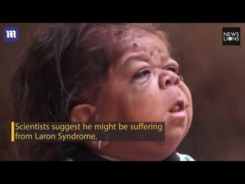 Pogledajte kako izgleda život 23-godišnjeg muškarca zarobljenog u tijelu bebe